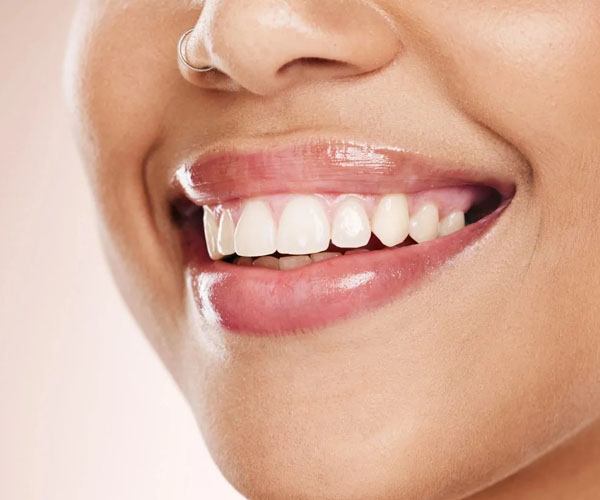 best teeth whitening dentist in Dubai