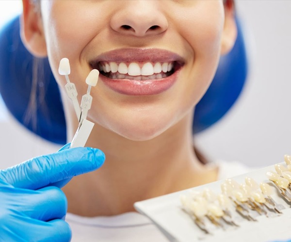 Porcelain Dental Veneers in Dubai