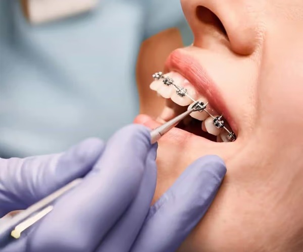 teeth braces price uae