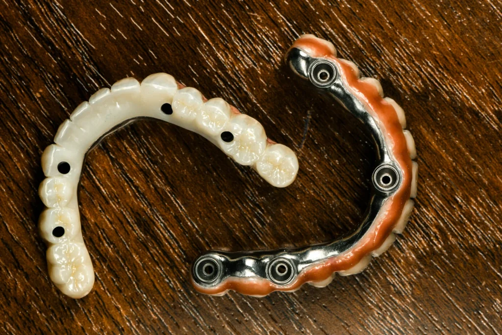 all on 4 implant surgery