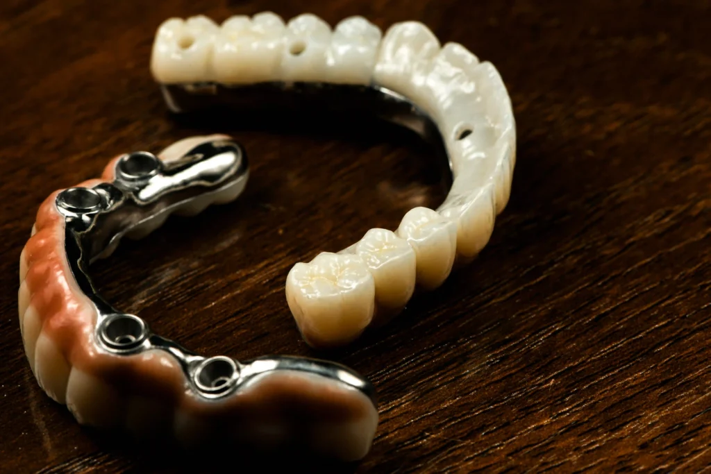 all on 4 implant surgery