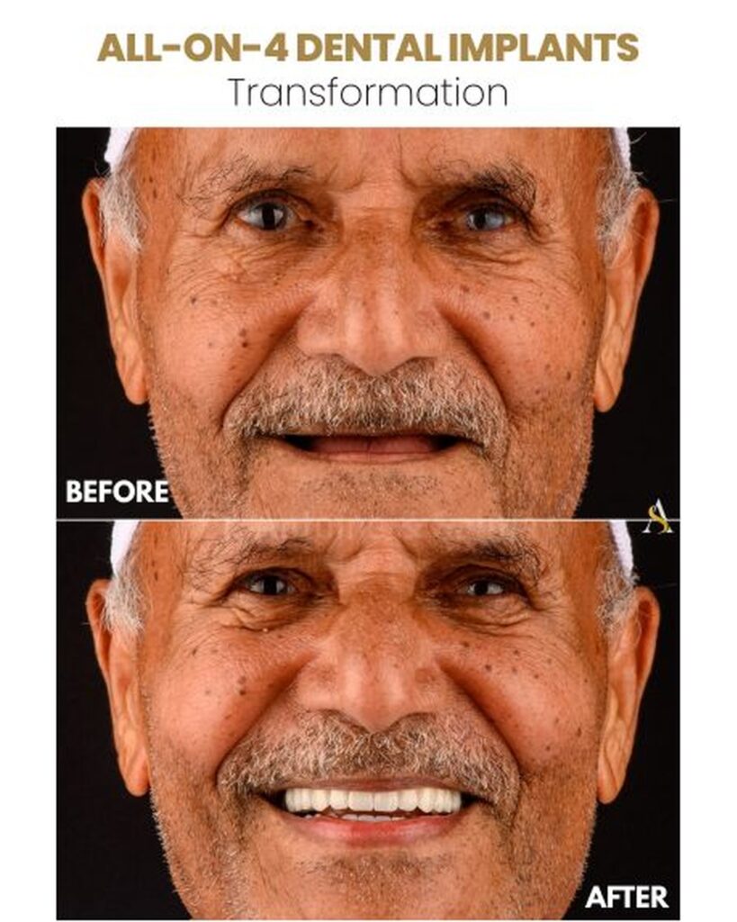 all_on_4_implants_4x5