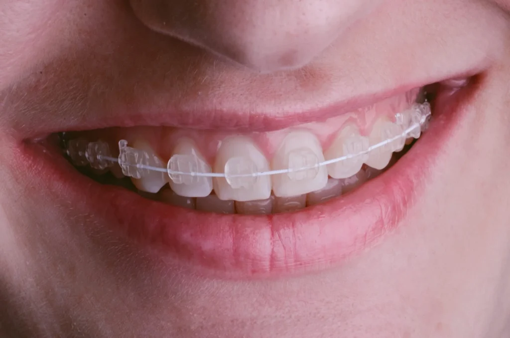 Ceramic Brace