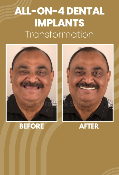 All-on-4 Dental Implants in dubai
