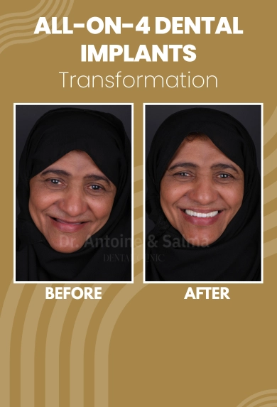 All-on-4 Dental Implants in dubai