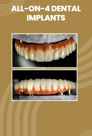 All-on-4 Dental Implants in dubai