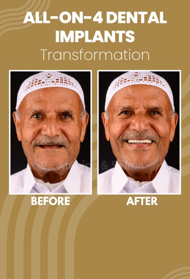 All-on-4 Dental Implants in Dubai