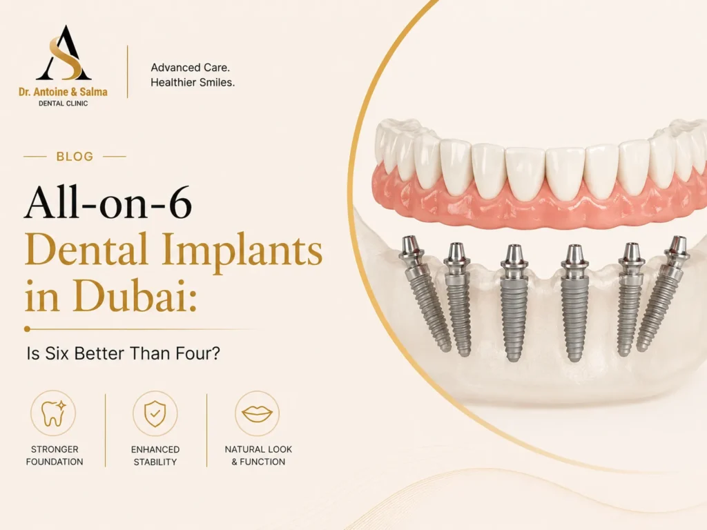 All-on-6 Dental Implants in Dubai: Is Six Better Than Four?
