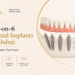 All-on-6 Dental Implants in Dubai: Is Six Better Than Four?