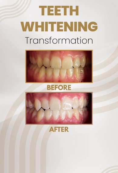 Teeth whi 2