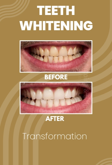 Teeth whitning 1
