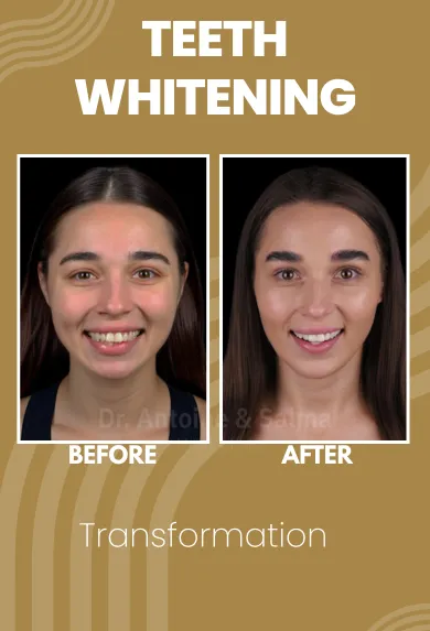 Teeth whitning 2